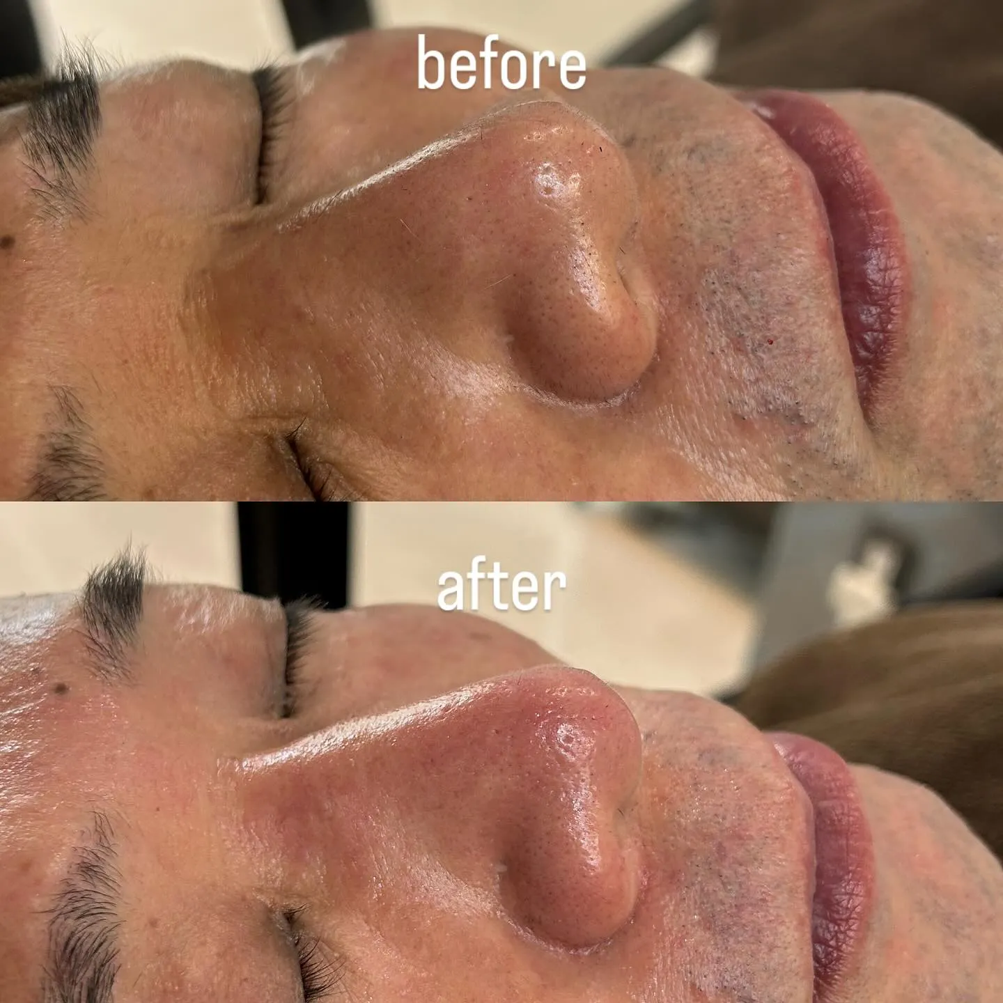 ［フェイシャル毛穴クレンジング］